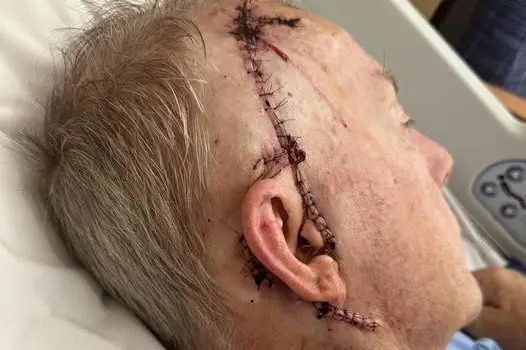 Member for Parkes Mark Coulton shared this graphic post-surgery photo while recuperating from surgery to remove his third melanoma and five lymph nodes. Photo: Supplied.