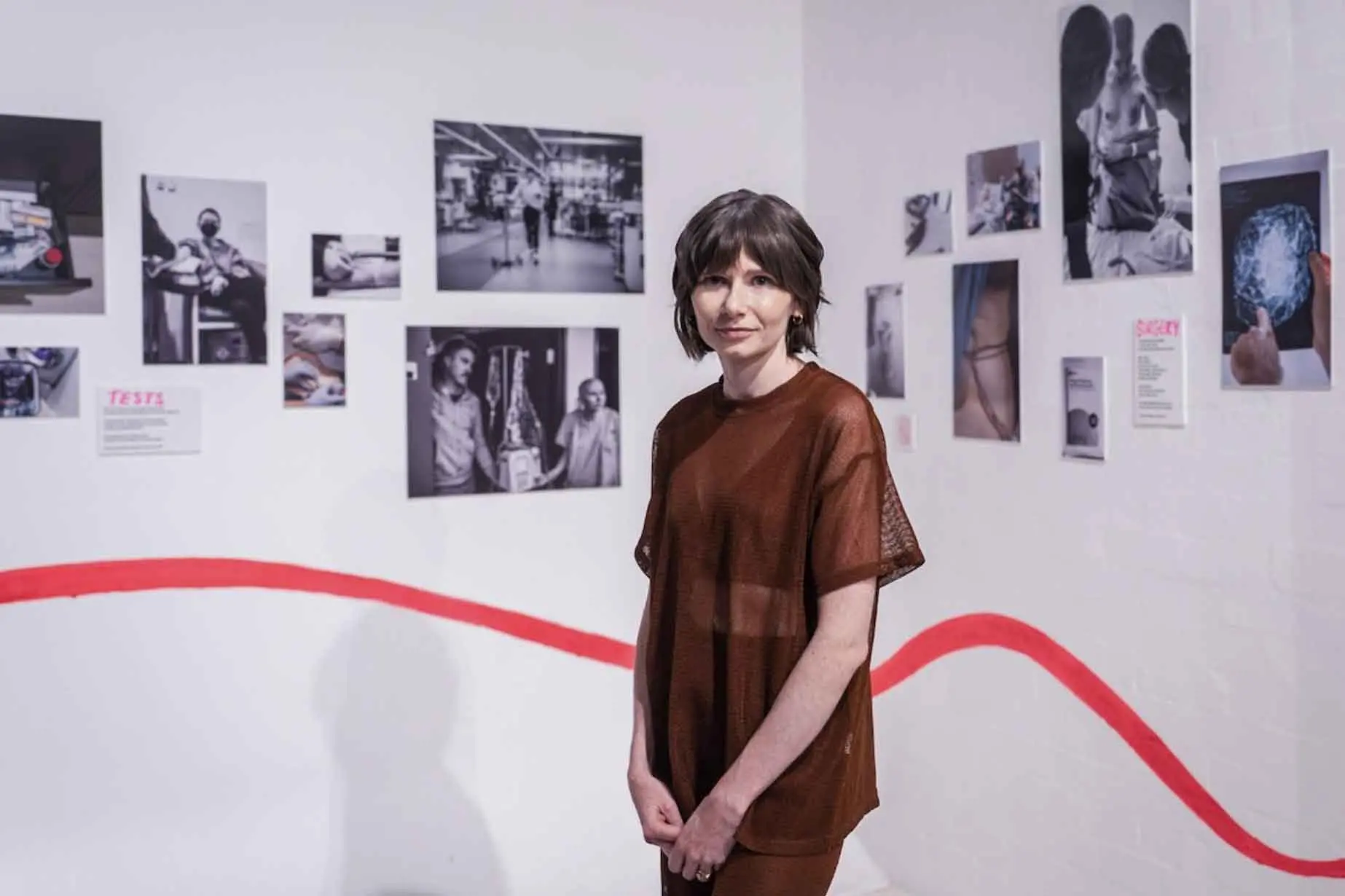 Hidden breast cancer costs increase burden of disease